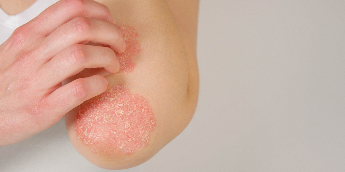 A cooling relief for Eczema and Psoriasis, Inside and Out!